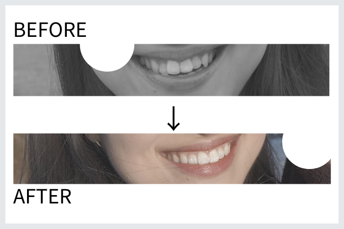 歯列矯正のビフォーアフター